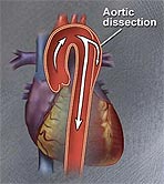 Aortic dissections1