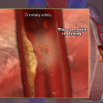 clot in artery